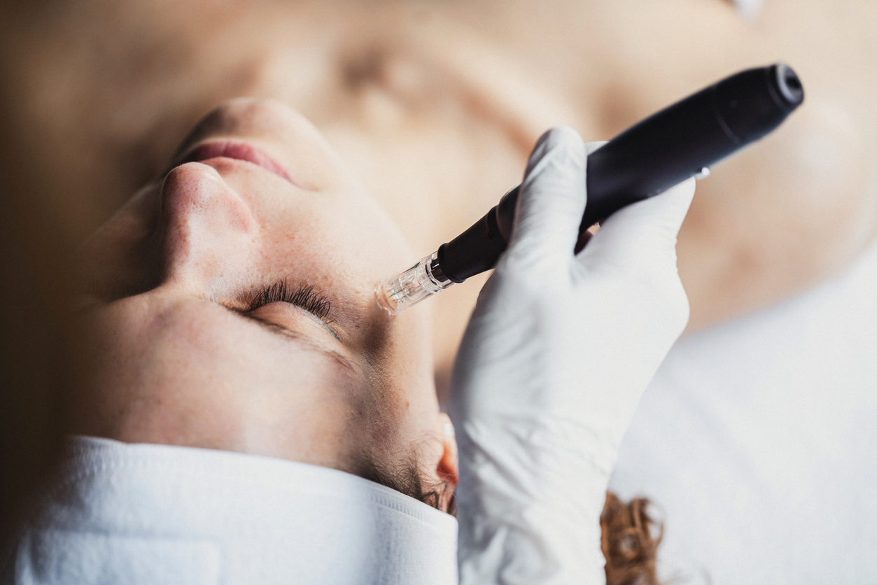 Medical Microneedling mit Microneedling-Pen an der Schläfe