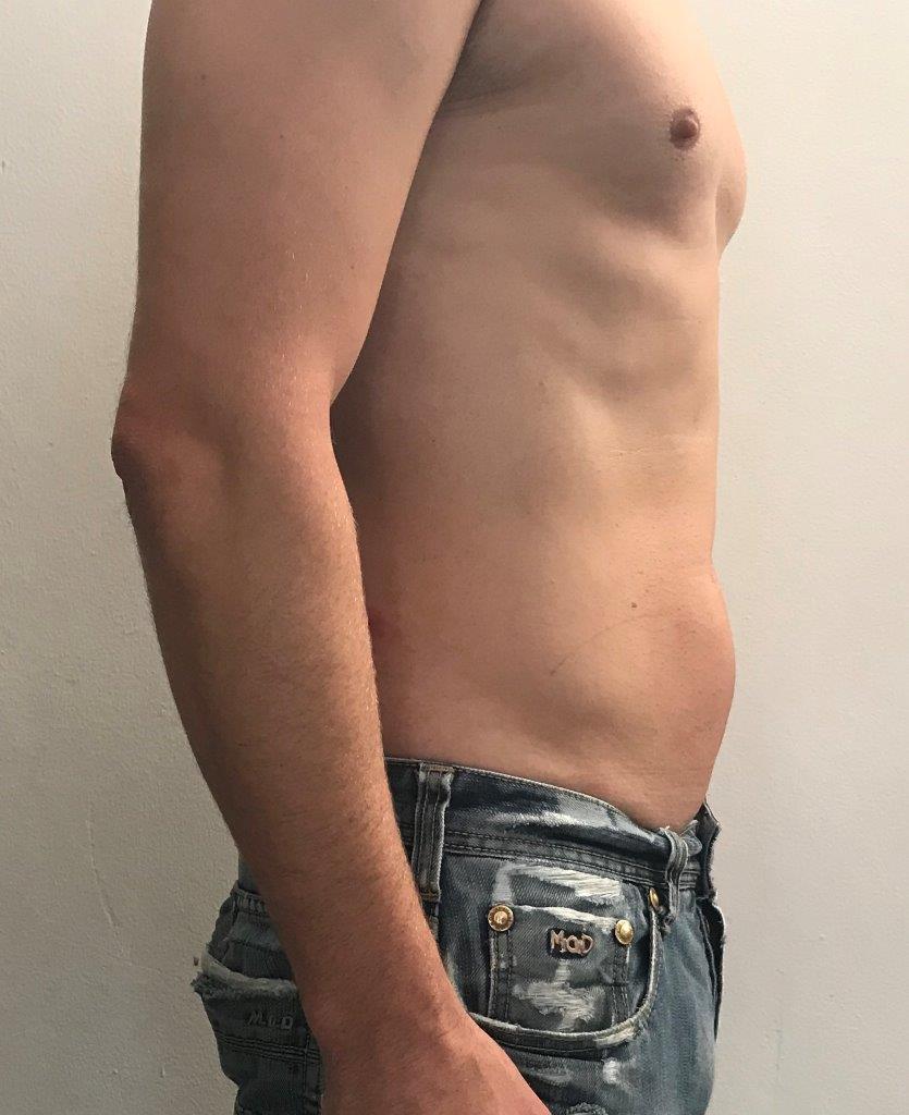 Bauch nach der Behandlung