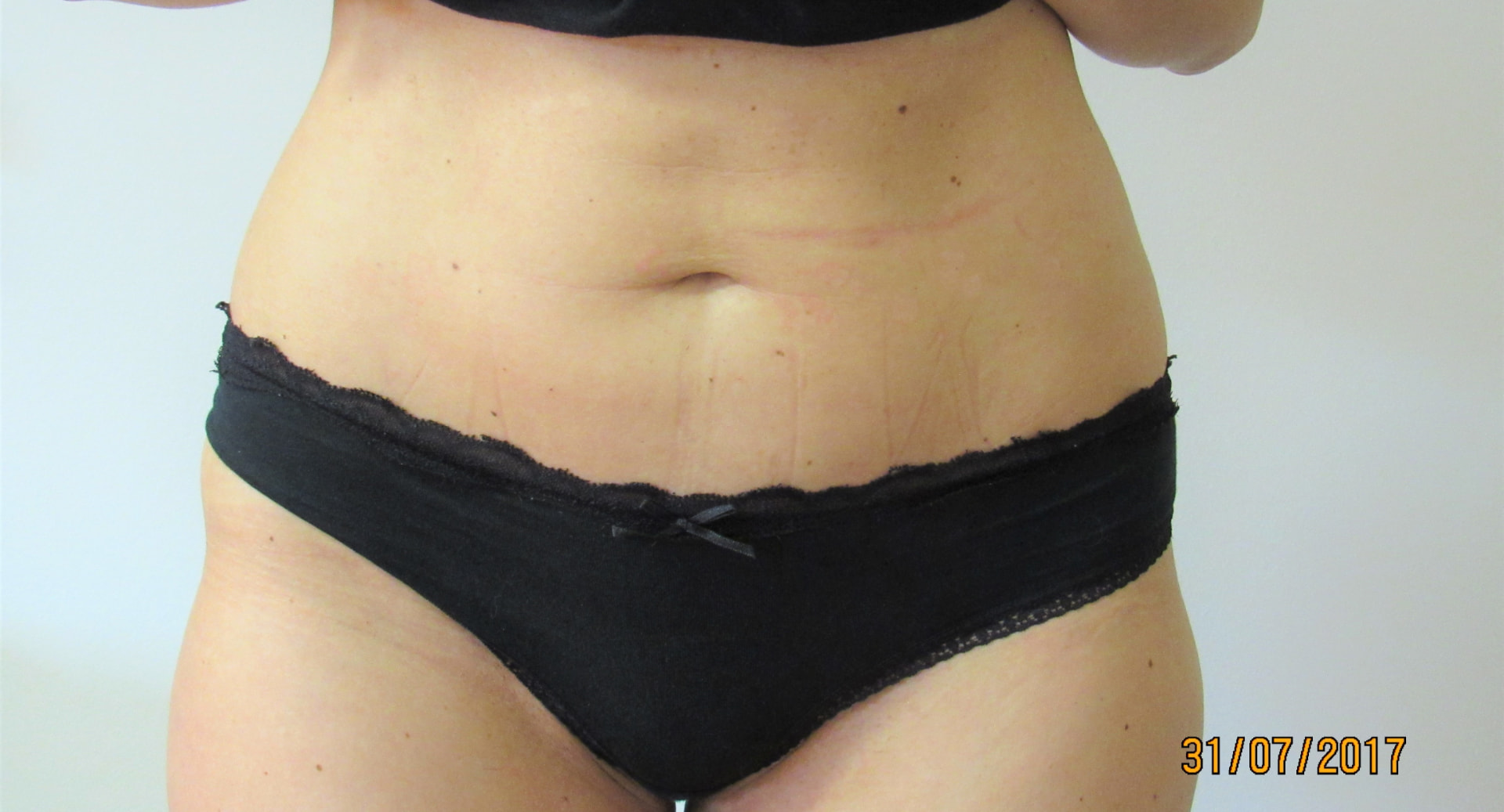 Bauch und Hüften nach der Behandlung