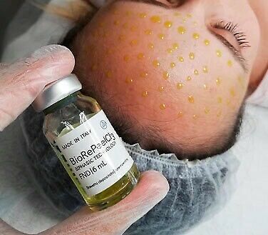 BioRePeel CL3: Ampulle mit biphasischer Lösung und aufgetropfte Stirn während der Behandlung