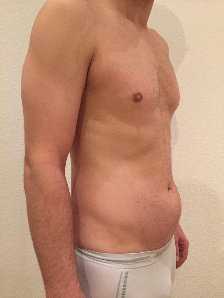 Bauch vor der Behandlung