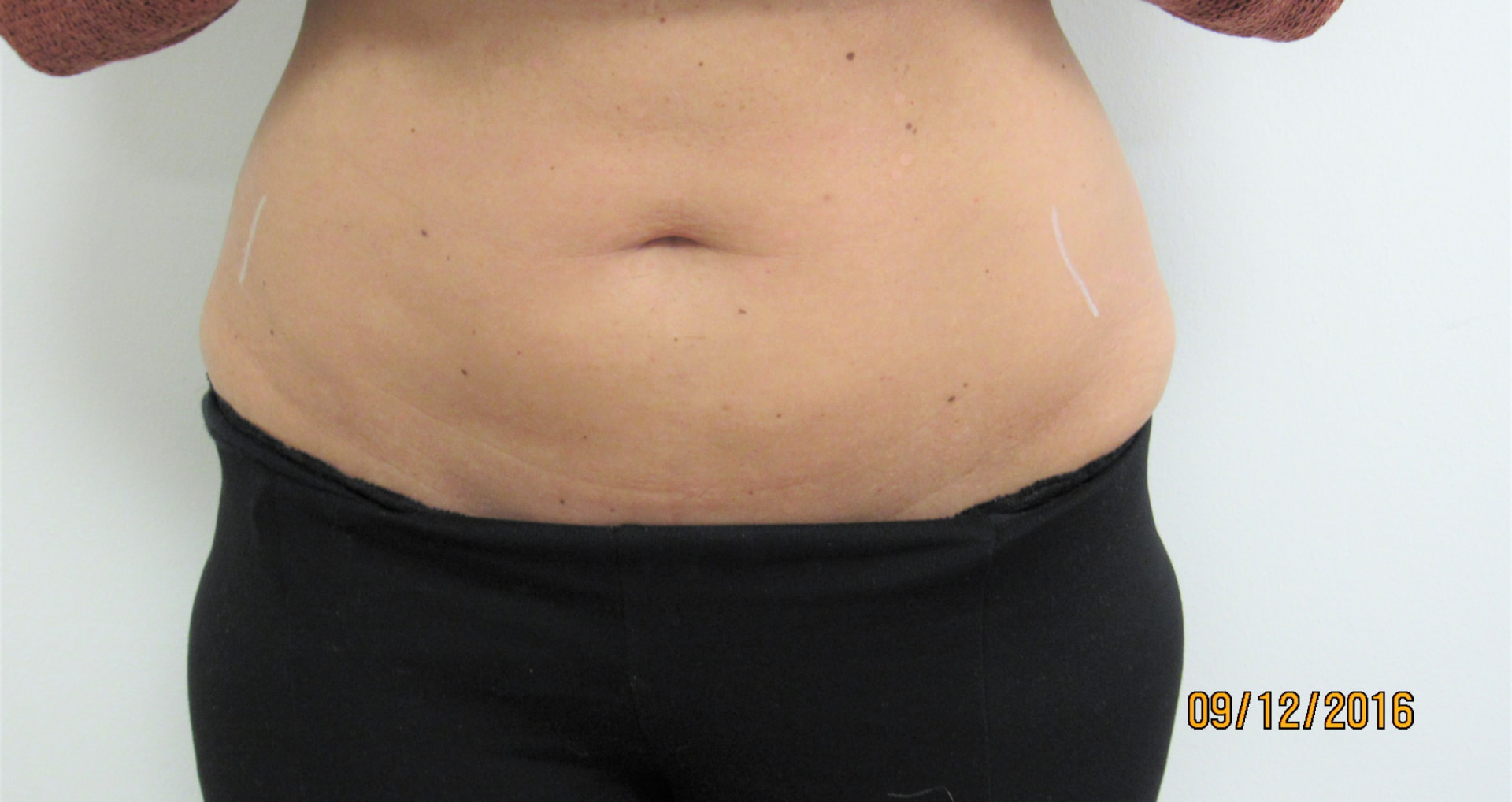 Bauch und Hüften vor der Behandlung